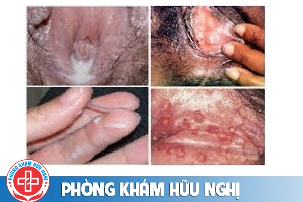 benh-lau-o-nu