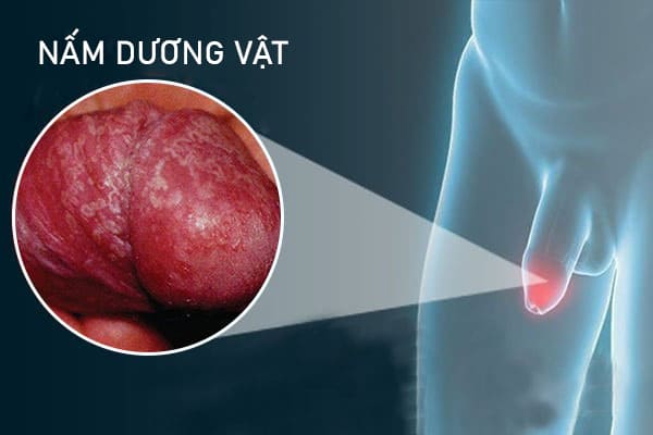 benh-nam-duong-vat-o-nam-gioi