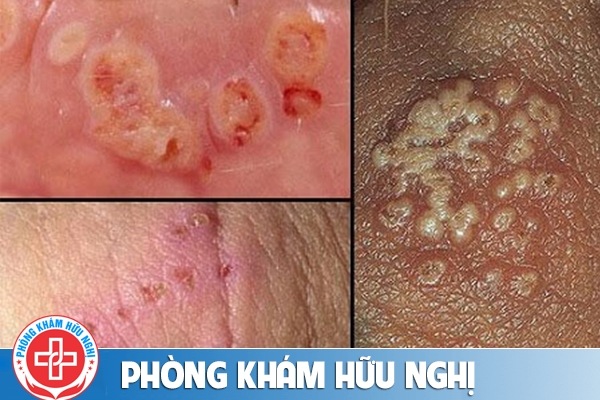 bieu-hien-benh-lau
