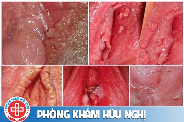 bieu-hien-cua-benh-sui-mao-ga-o-nu-gioi