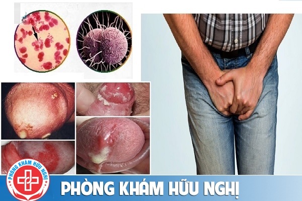 cach-phat-hien-benh-lau