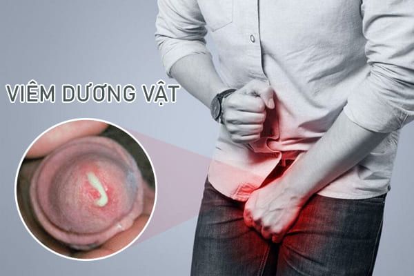 dau-hieu-viem-duong-vat