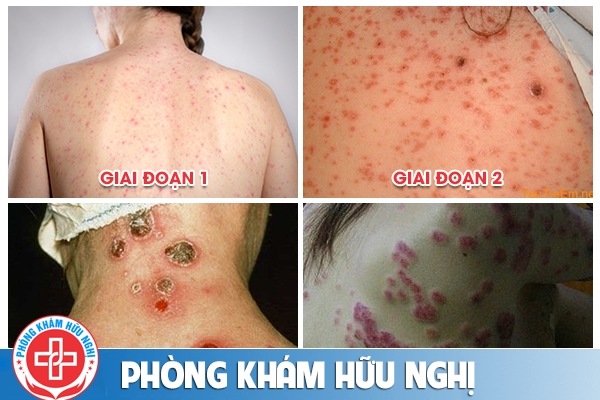 dia-chi-chua-benh-giang-mai-an-toan-o-nghe-an-1