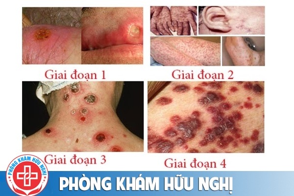 giang-mai-giai-doan-cuoi
