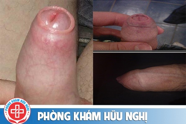 hep-bao-quy-dau-002