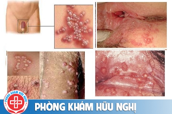 mun-rop-sinh-duc-nam-hieu-qua