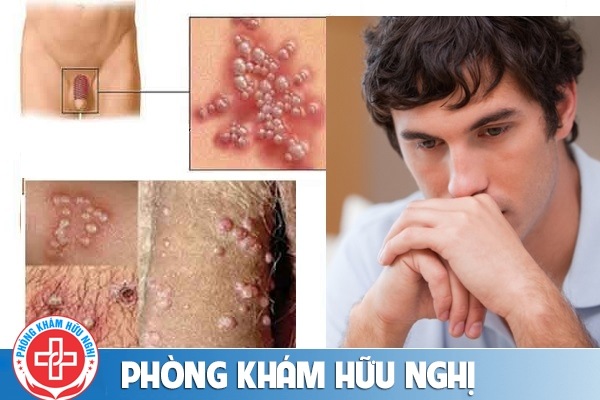 mun-rop-sinh-duc-nam-hieu-qua