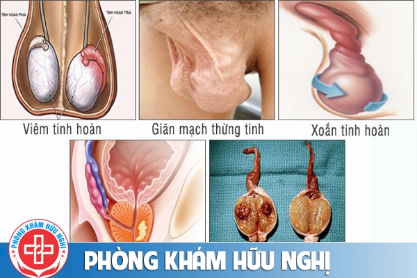 nhung-can-benh-co-trieu-chung-dau-tinh-hoan-phai-6