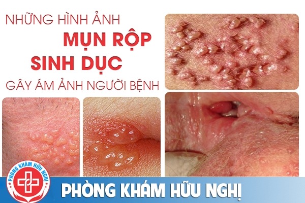 nhung-hinh-anh-mun-rop-sinh-duc-gay-am-anh-nguoi-benh