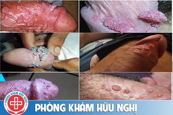 sui-mao-ga-duong-vat
