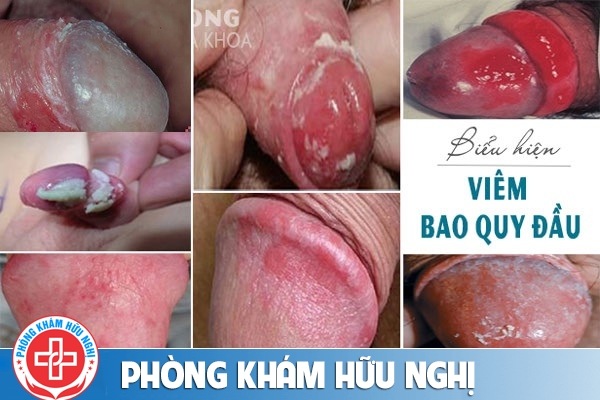 tac-hai-benh-viem-bao-quy-dau