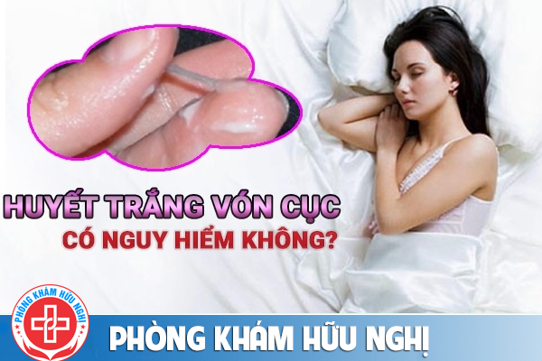 Mối nguy hiểm khó lường khi huyết trắng vón cục