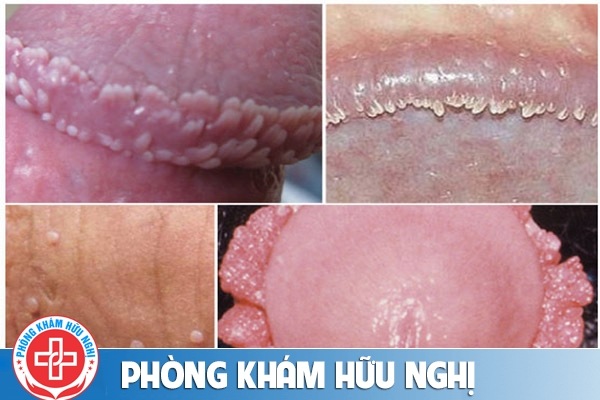 Nguyên nhân b?nh sùi mào gà ? Nam gi?i
