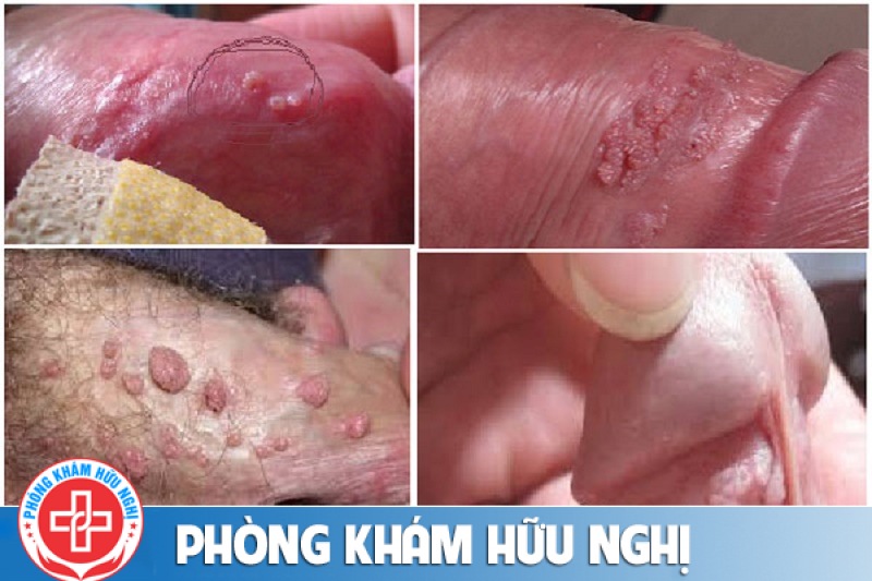 triue-chung-sui-mao-ga-nam
