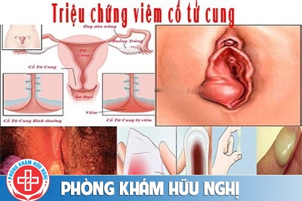 viem-co-tu-cung