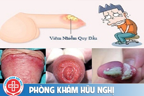 viem-nhiem-quy-dau