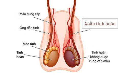 Xoắn tinh hoàn: Chậm một khắc hỏng cả bộ phận