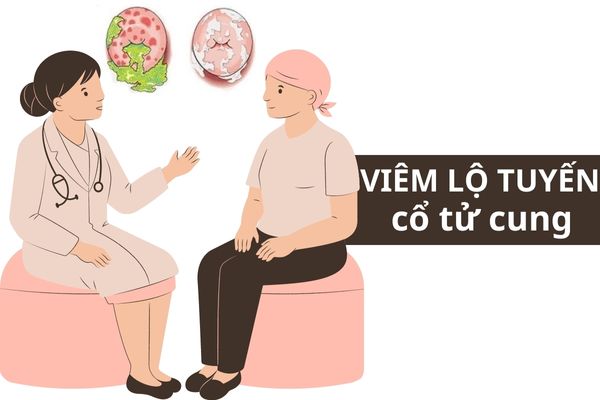 Cách nhận biết viêm lộ tuyến cổ tử cung ở nữ giới