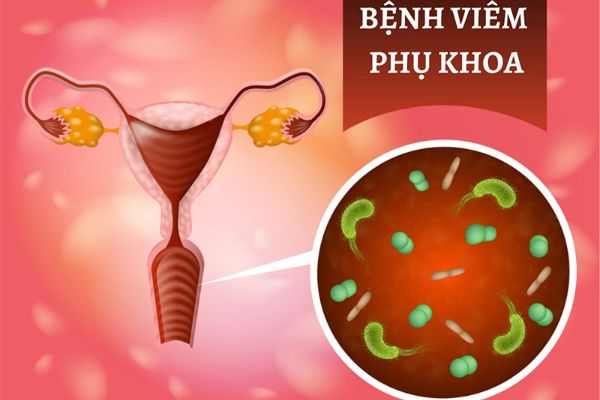 Hỗ trợ điều trị viêm phụ khoa như thế nào hiệu quả?