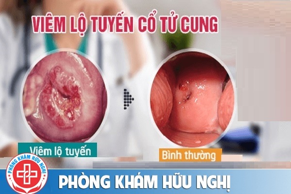 viem-lo-tuyen-co-tu-cung-nguy-hiem
