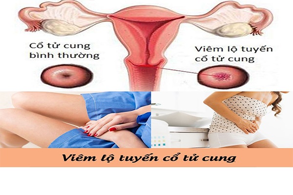 viem-lo-tuyen-co-tu-cung-nguy-hiem