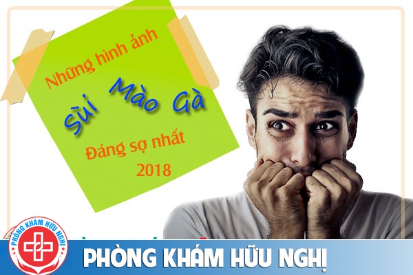 Những hình ảnh sùi mào gà đáng sợ