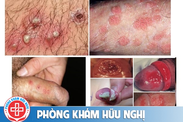 noi-mun-o-duong-vat