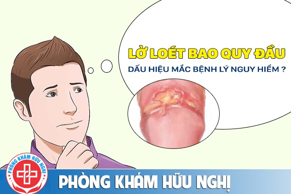 Nam giới bị lở loét bao quy đầu là bệnh gì và phải làm thế nào để chữa trị ?