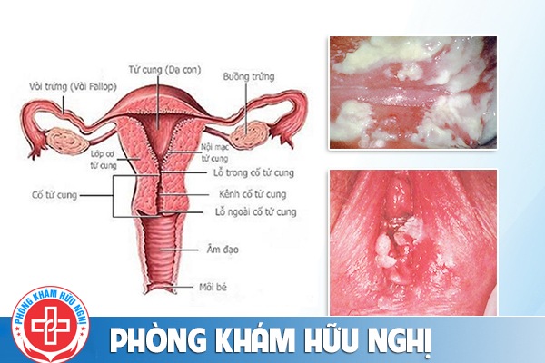 Viêm phụ khoa