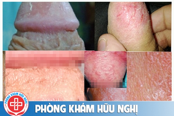 loét quy đầu