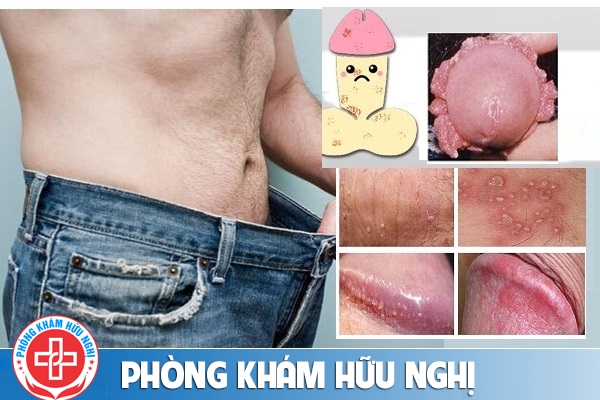 quy-dau-noi-mun