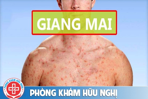 Hình ảnh bệnh giang mai một trong số những bệnh đường tình dục đáng sợ nhất