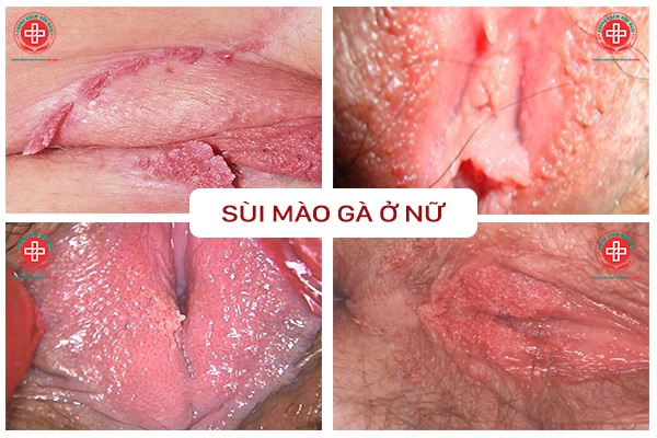 noi-mun-am-dao-la-benh-gi