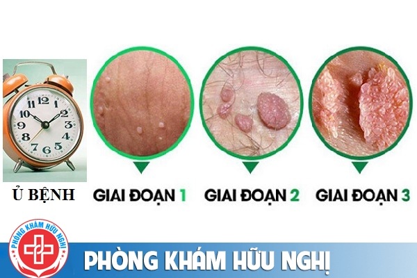 thoi-gian-phat-benh-sui-mao-ga