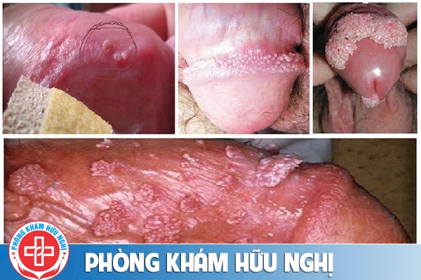 trieu-chung-sui-mao-ga-o-nam-gioi