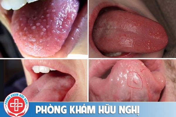 sui-mao-ga-o-luoi-giai-doan-dau-01