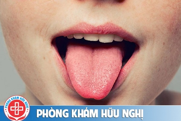 Bị nổi mụn ở lưỡi nghĩ ngay là sùi mào gà