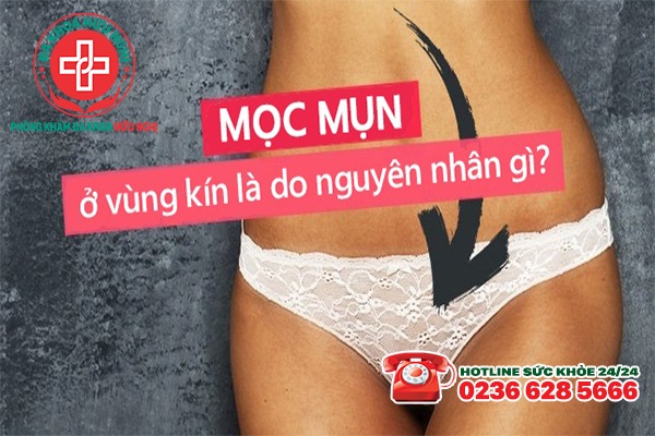 Mọc mụn thịt ở vùng kín là mắc bệnh gì?
