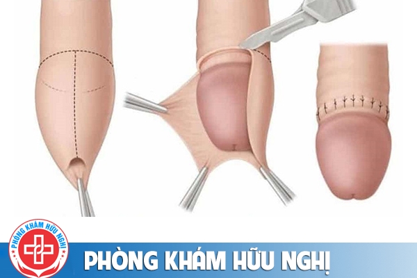Ưu điểm cắt bao quy đầu công nghệ xâm lấn tối thiểu Hàn Quốc