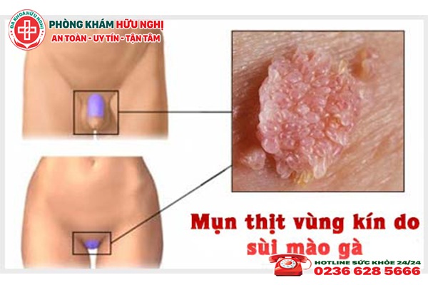 mun-thit-vung-kin-do-sui-mao-ga