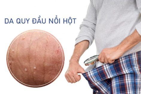 Da quy đầu nổi hột là bị bệnh gì?