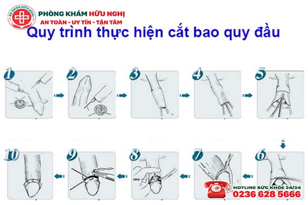 Quy trình cắt bao quy đầu 