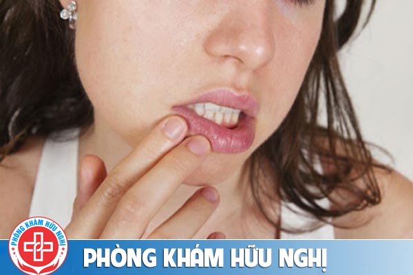 Chữa sùi mào gà ở miệng bằng phương pháp nào hiệu quả?