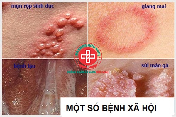 benh-xa-hoi