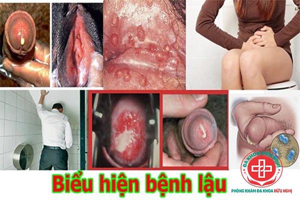 trieu-chung-benh-lau