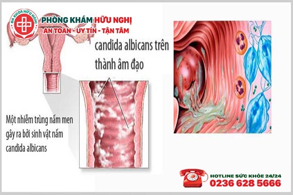 trieu-chung-cua-benh-viem-am-dao