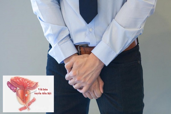 Những điều cần biết về vôi hóa tuyến tiền liệt