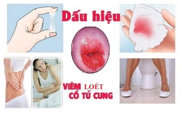 dau-hieu-viem-loet-co-tu-cung-va-cach-dieu-tri-hieu-qua-02