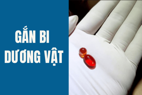 Gắn bi dương vật ở đâu an toàn?