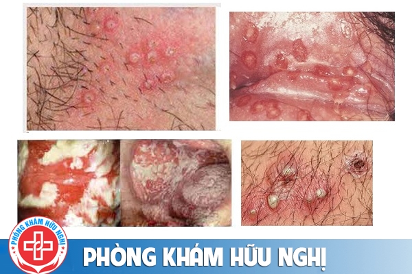 ngua-vung-kin-nu-nguyen-nhan